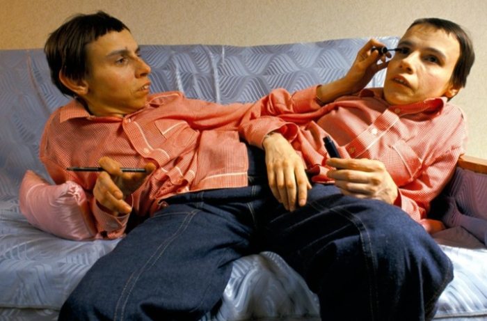 When Two Brains Become One: The Shocking Truth About 10 Pairs of Connected Twins.