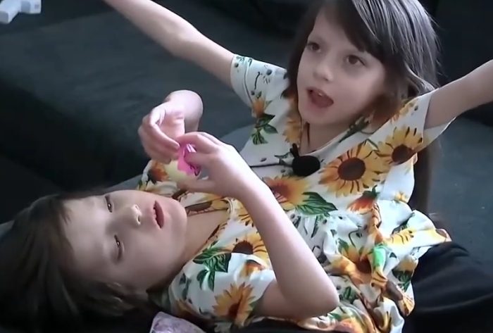 When Two Brains Become One: The Shocking Truth About 10 Pairs of Connected Twins.