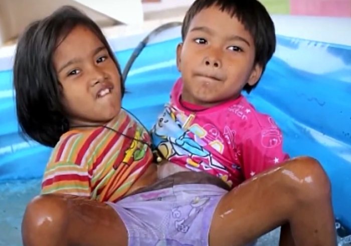 When Two Brains Become One: The Shocking Truth About 10 Pairs of Connected Twins.