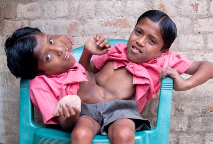 When Two Brains Become One: The Shocking Truth About 10 Pairs of Connected Twins.