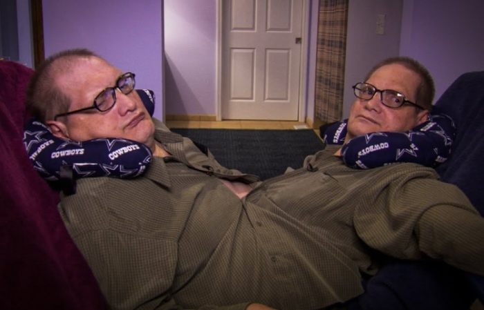 When Two Brains Become One: The Shocking Truth About 10 Pairs of Connected Twins.