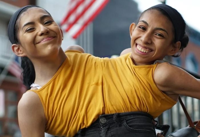 When Two Brains Become One: The Shocking Truth About 10 Pairs of Connected Twins.