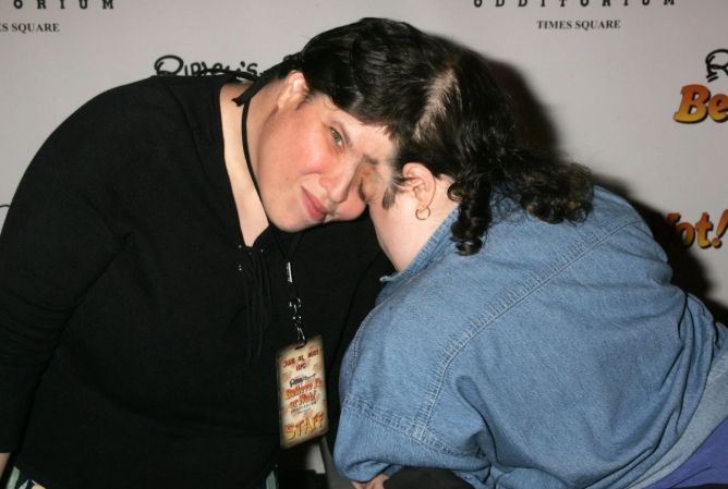 When Two Brains Become One: The Shocking Truth About 10 Pairs of Connected Twins.