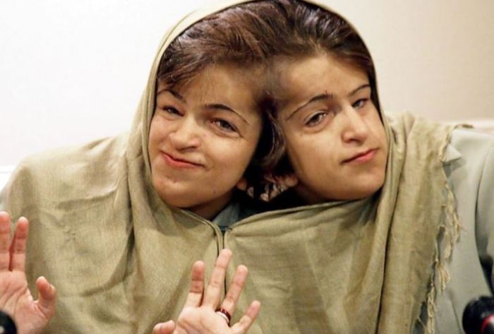 When Two Brains Become One: The Shocking Truth About 10 Pairs of Connected Twins.